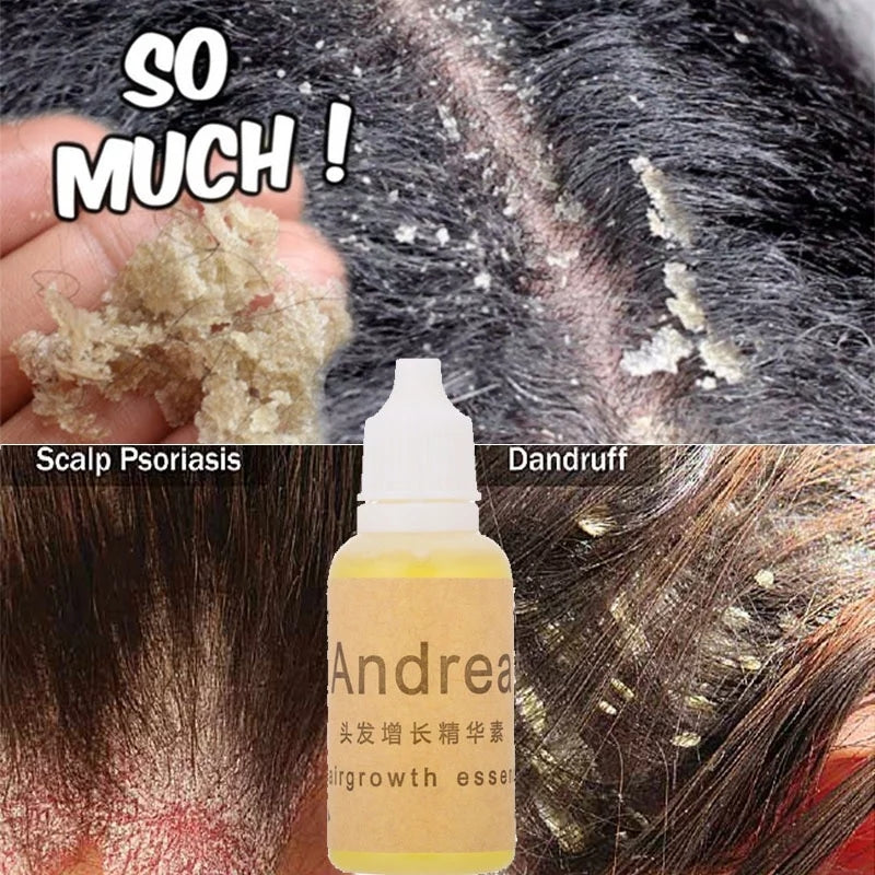 Anti Dandruff Essential Oils Fast Get Rid of Anti Dandruff  Hair Loss Scalp Cleaning Dandruff Repair Health Care