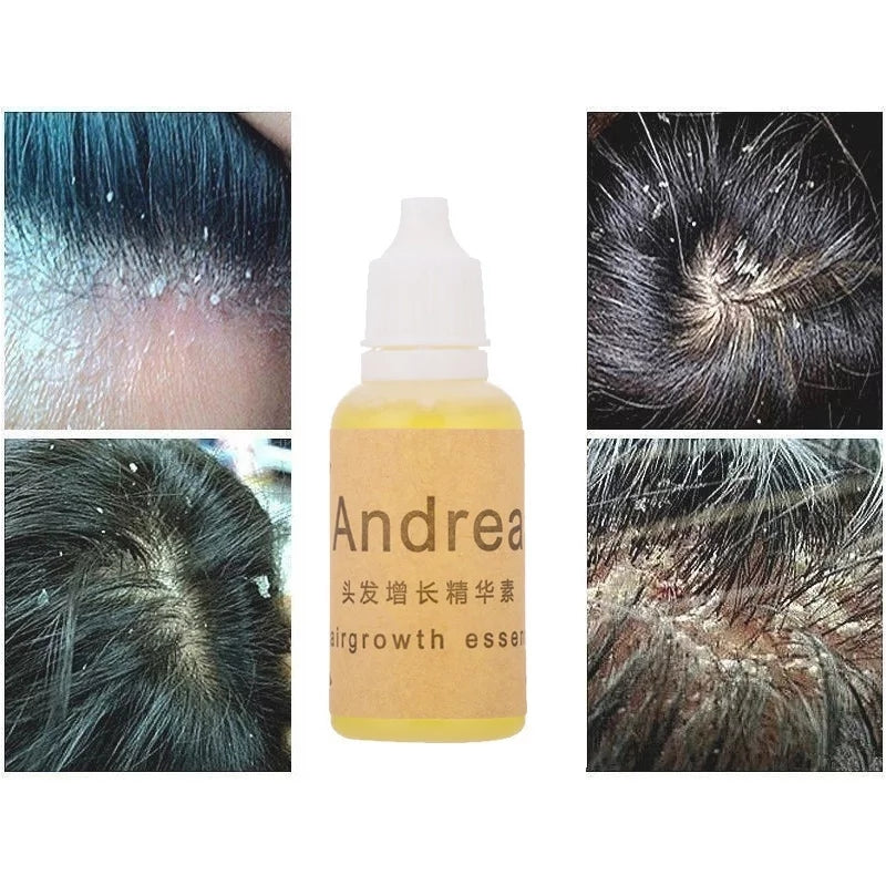 Anti Dandruff Essential Oils Fast Get Rid of Anti Dandruff  Hair Loss Scalp Cleaning Dandruff Repair Health Care